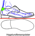 Durch die Aussparung und Auspolsterung im Exostosenbereich wird eine Druckentlastung erzeugt, damit verringert sich der Reibungsdruck der Hinterkappe des Schuhes im Fersen- bzw Achillessehnenbereiches.