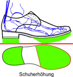 Durch eine einseitige Erhöhung wird die fehlende Beinlänge ausgeglichen. Damit wird das Becken gerade gestellt und ein vorzeitiger Verschleiß der Wirbelsäule vermieden.